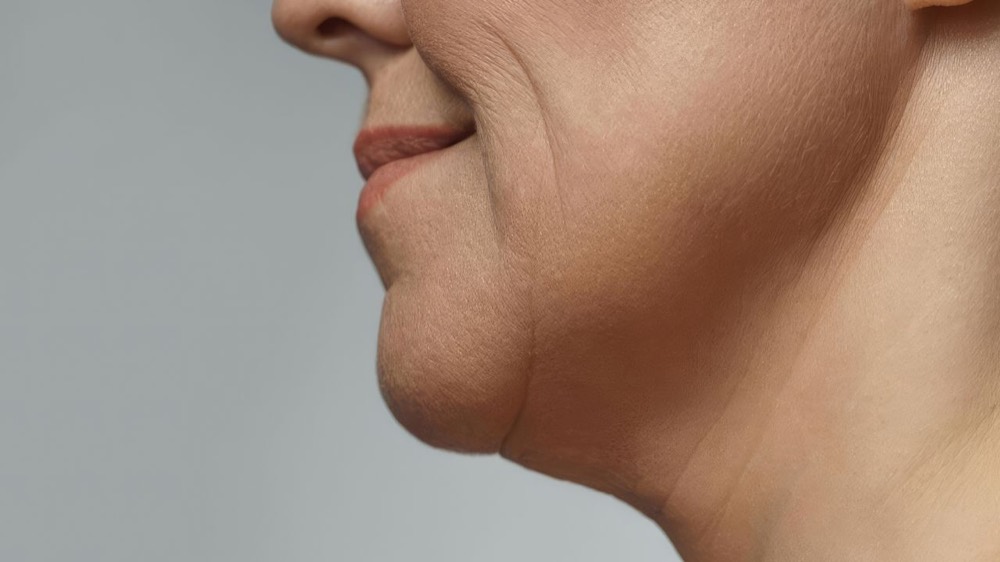 Radiofrequency Skin Tightening